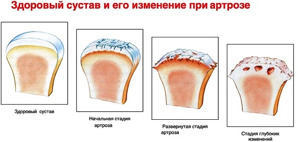 Приглашаем на "Школу артроза"