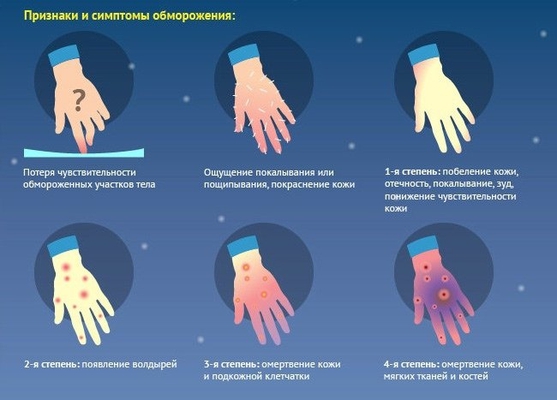 Осторожно! Обморожение!